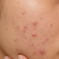 ACNE & BREAKOUTS