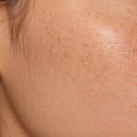 FRECKLES
