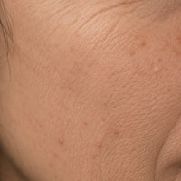 WRINKLES